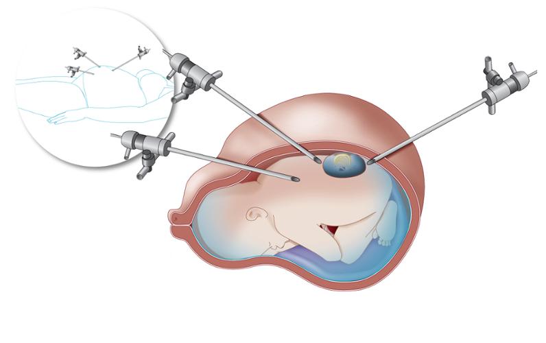 Фетальная хирургия. Фетоскопия. Фетальная хирургия:. Фетальная хирургия операции.